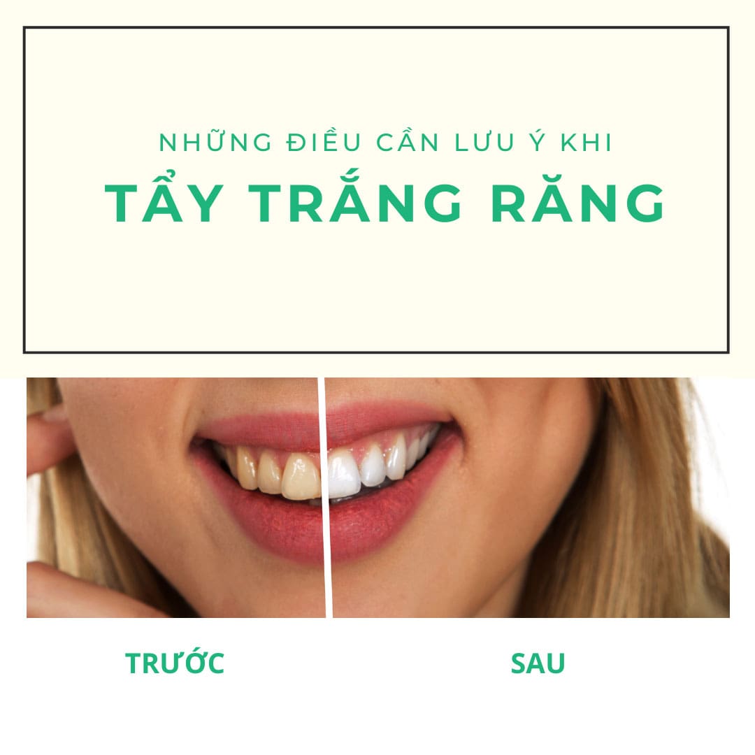 Tẩy trắng răng 13 Những điều cần lưu ý khi tẩy trắng răng