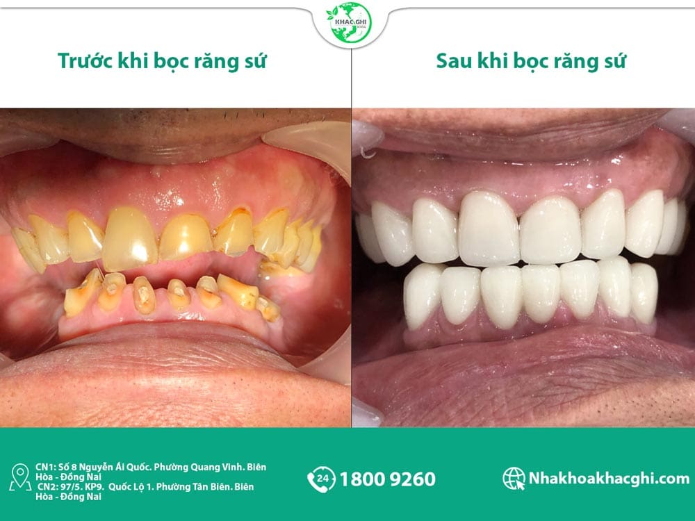 Bọc răng sứ thẩm mỹ là gì