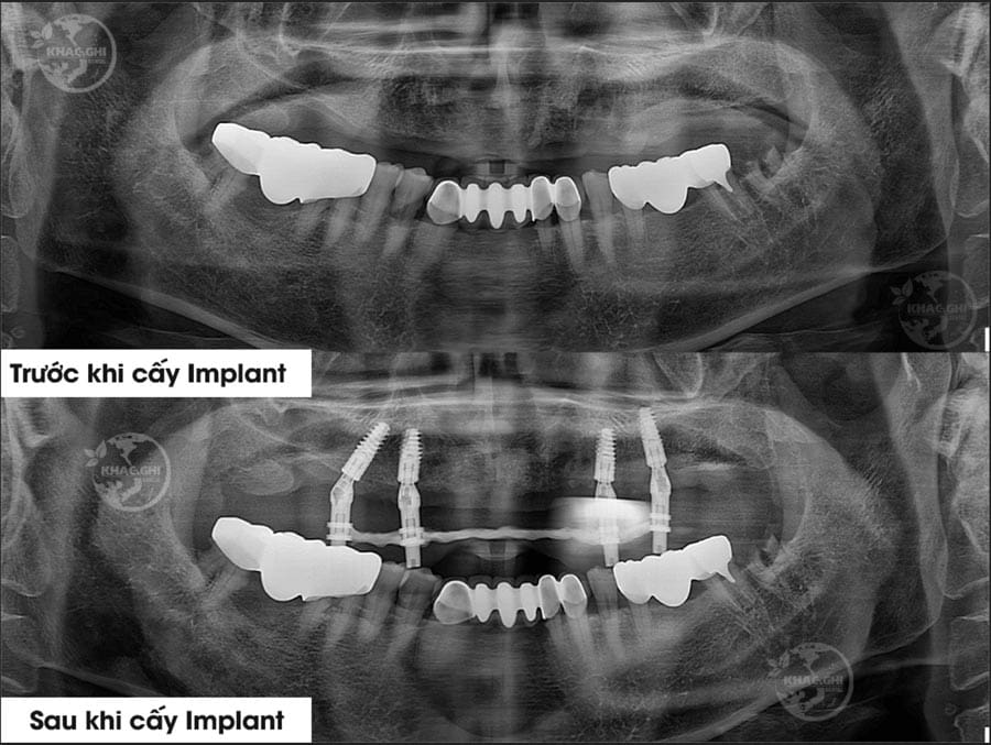Ảnh chụp x-quang trước và sau khi trồng implant nhakhoakhacghi