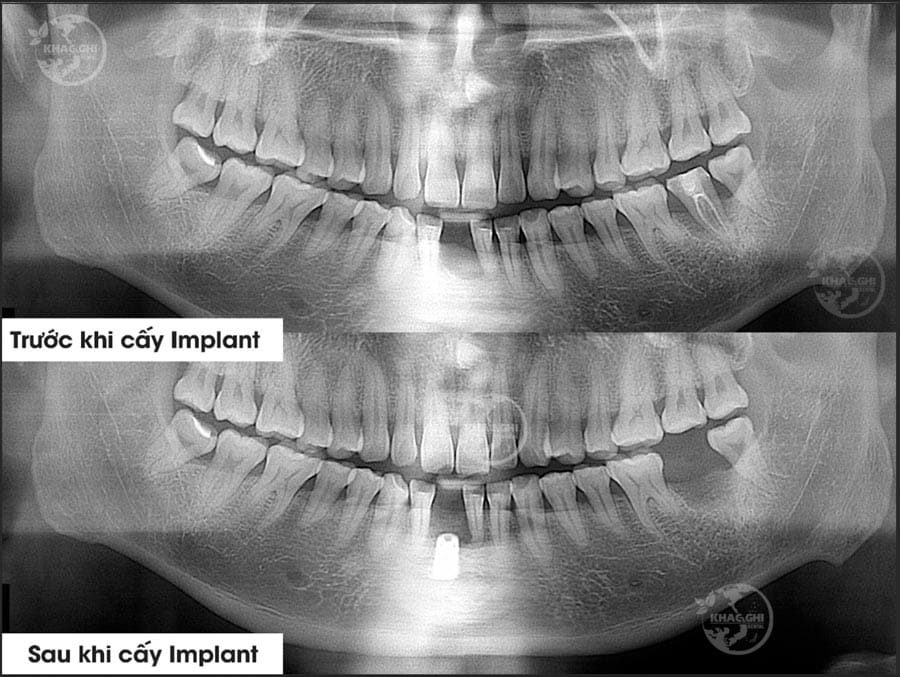 Ảnh chụp x-quang trước và sau khi trồng implant nhakhoakhacghi