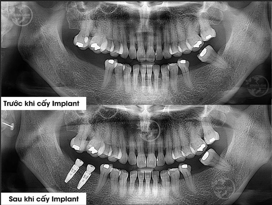 Ảnh chụp x-quang trước và sau khi trồng implant nhakhoakhacghi