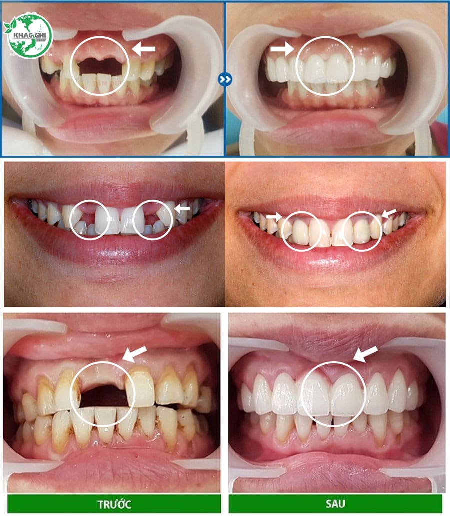 anh truoc sau cay implant nhakhoakhacghi