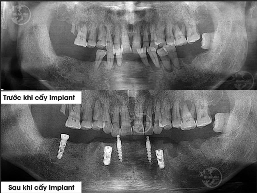 anh truoc sau cay implant nhakhoakhacghi