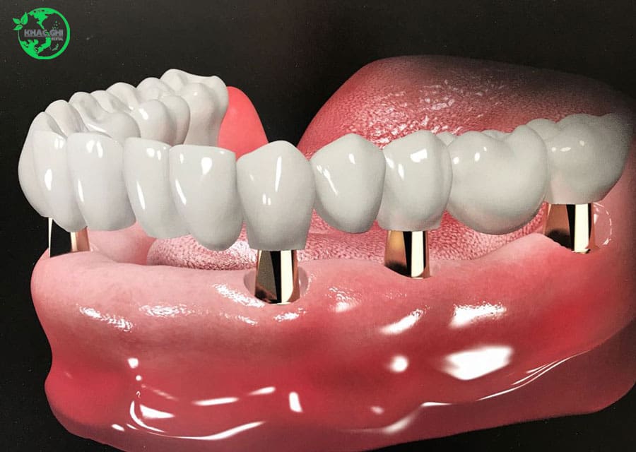trong implant giai phap khac phuc mat rang nhakhoakhacghi