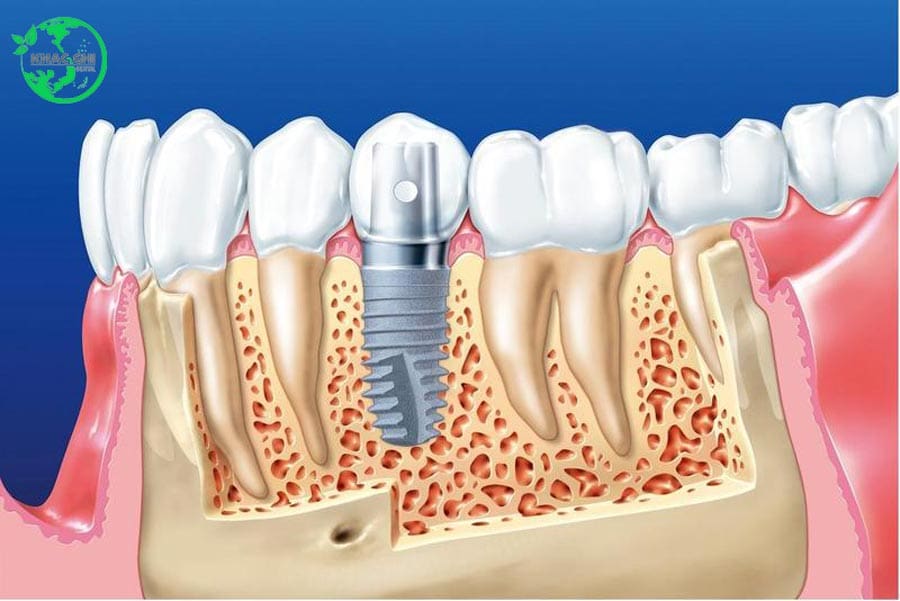 trong implant giai phap khac phuc mat rang nhakhoakhacghi