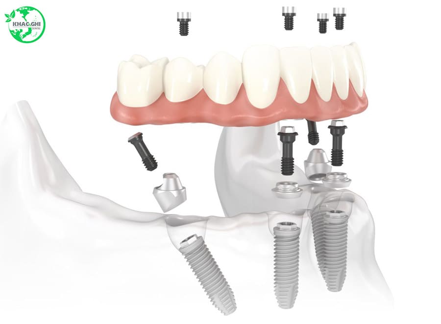 cay ghep implant all on 4 nhakhoakhacghi