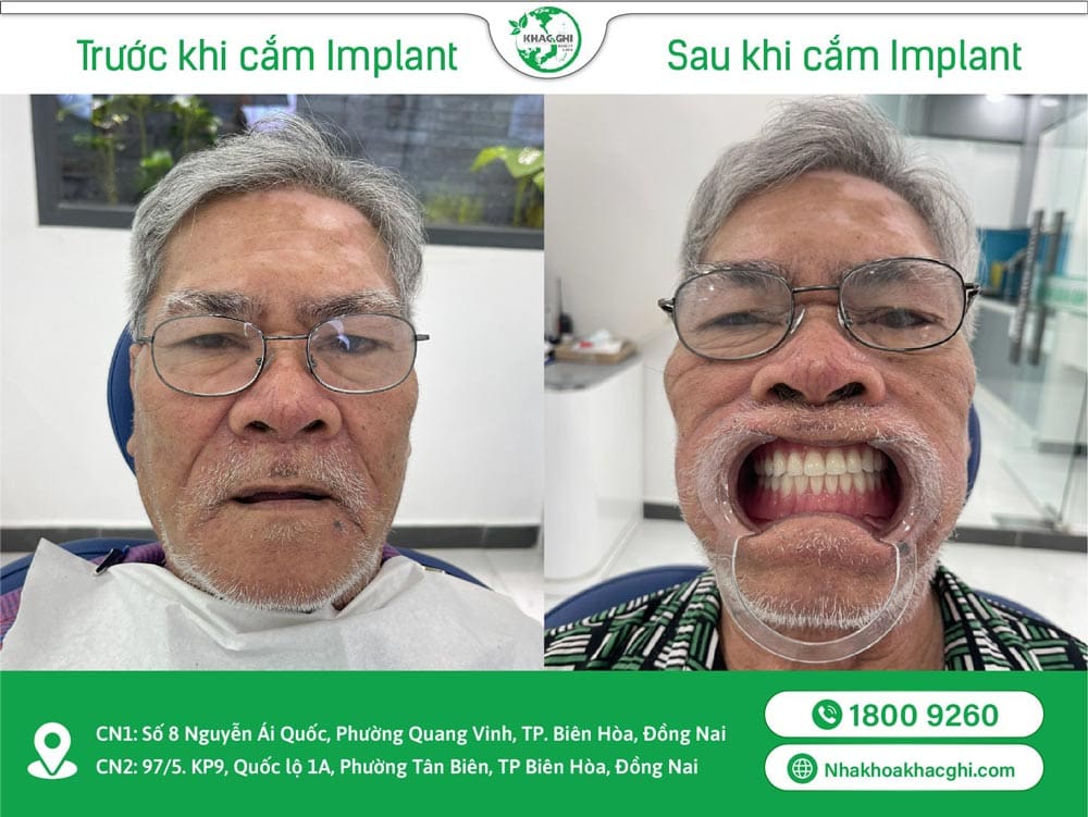 Khách hàng cấy ghép implant tại Nha Khoa Khắc Ghi
