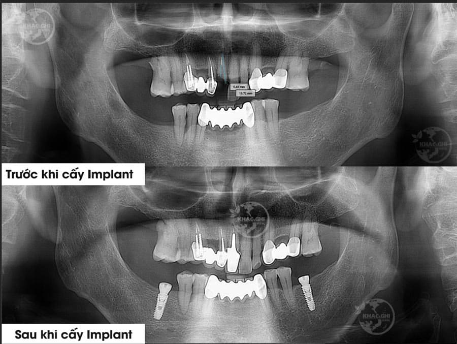 anh truoc sau cay implant nhakhoakhacghi