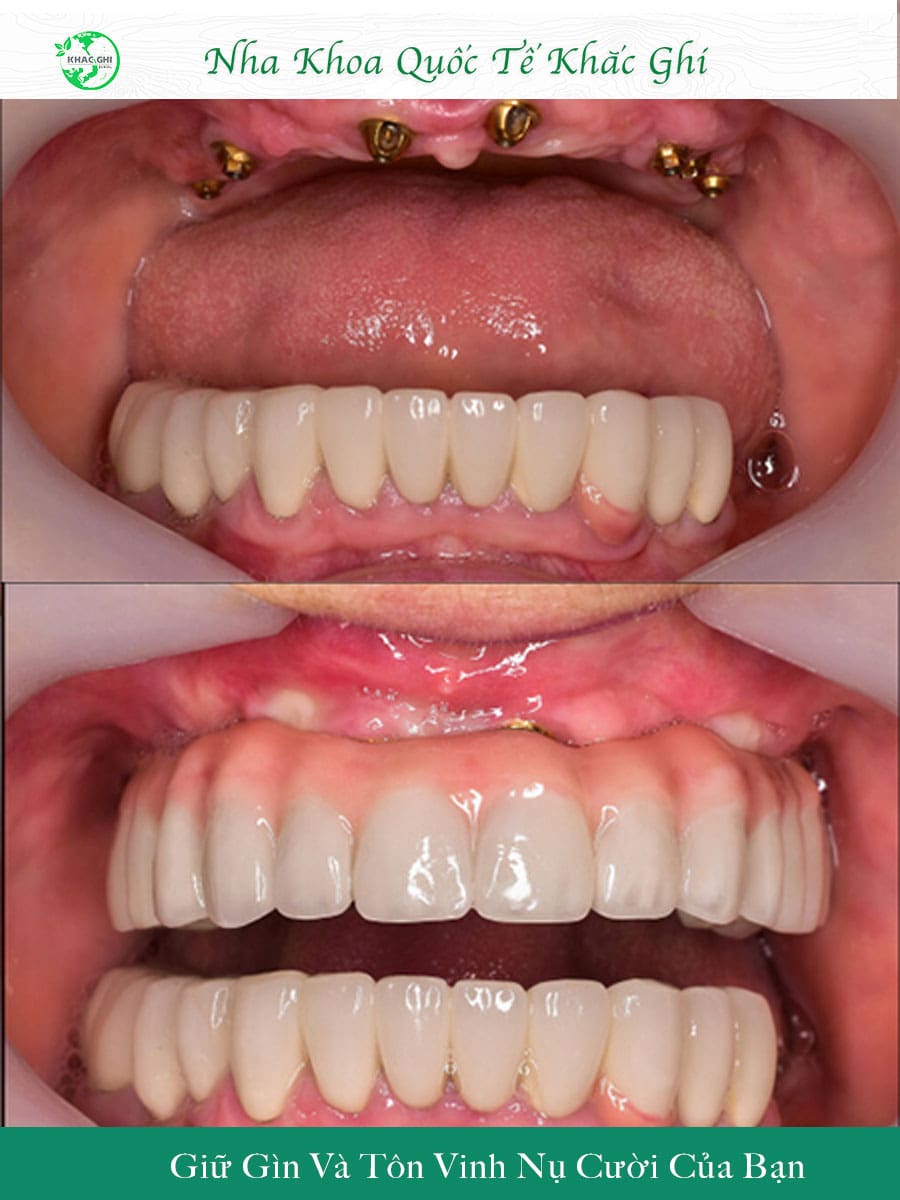 anh truoc sau cay implant nhakhoakhacghi