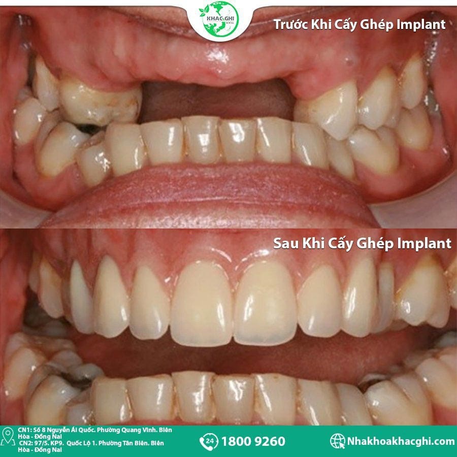 anh truoc sau cay implant nhakhoakhacghi