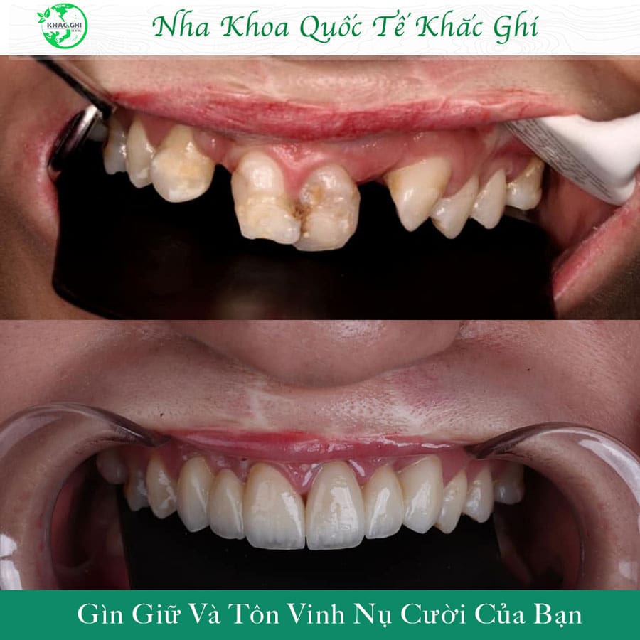 Ưu Nhược Điểm Của Trồng Răng Implant: Những Điều Cần Biết 2025 34 anh truoc sau cay implant nhakhoakhacghi