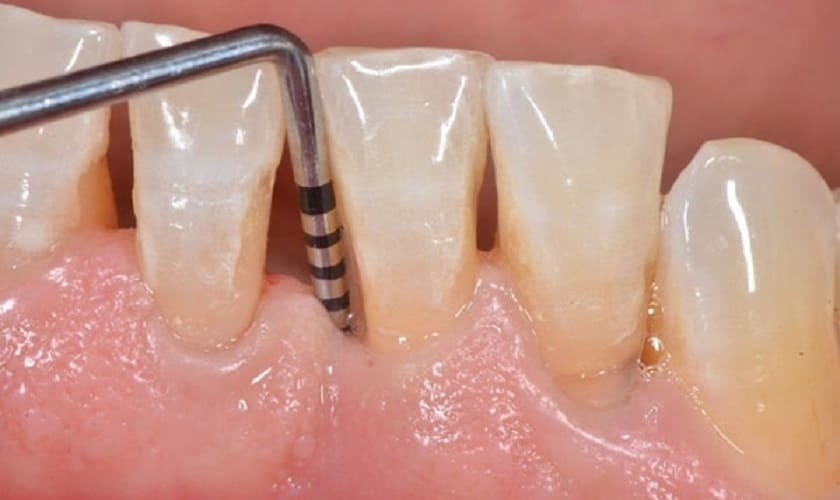 Ưu Nhược Điểm Của Trồng Răng Implant: Những Điều Cần Biết 2025 21 uu nhuoc diem trong rang implant 3