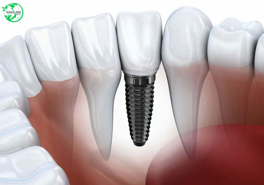 Ưu Nhược Điểm Của Trồng Răng Implant: Những Điều Cần Biết 2025 24 trong implant giai phap khac phuc mat rang nhakhoakhacghi